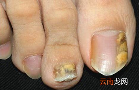 灰指甲6天自愈方法 灰指甲最开始的症状会发脓吗