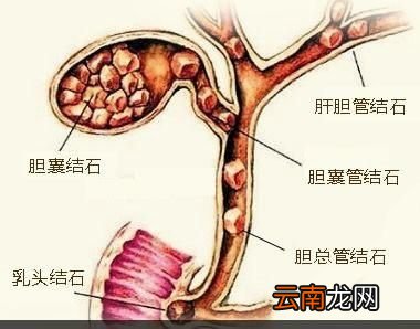 胆结石形成的原因有哪些