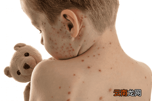 宝宝长水痘怎么治疗 宝宝长水痘护理方法