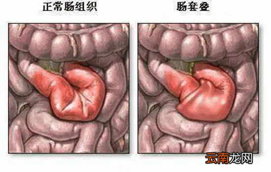肠套叠的三大典型症状 家长应警惕这三大症状