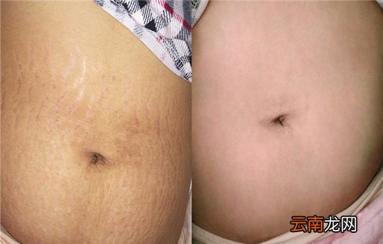 去妊娠纹用什么牌子的产品有效 曼菲秀让你在祛纹路上少走弯路