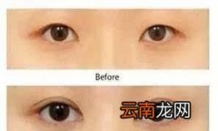 双眼皮开眼角后要休息多久