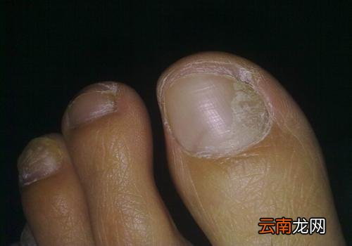 灰指甲不治疗的后果 灰指甲不治疗的后果会怎样