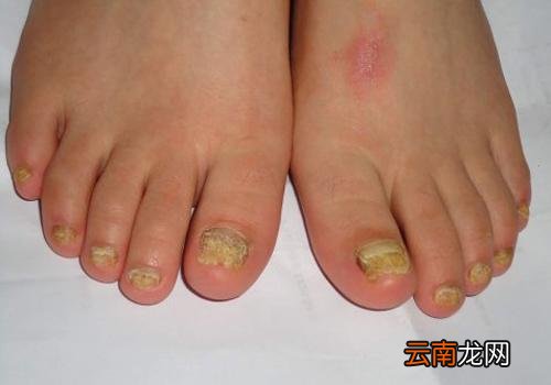 灰指甲是怎么引起的有什么危害 灰指甲是怎么引起的