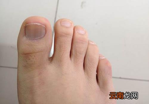 灰指甲涂抹什么药好使 灰指甲擦什么药最有效