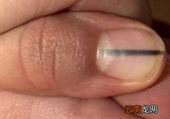 指甲里面有黑线是癌症吗 指甲上有黑线是癌症吗