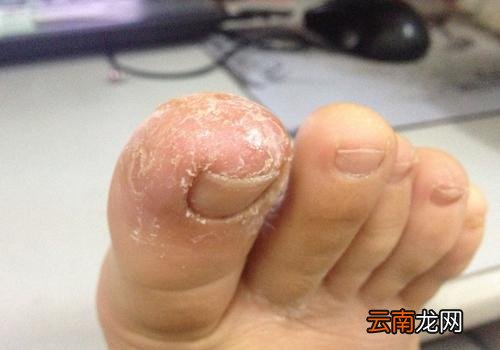 足癣用什么喷雾 足癣用什么