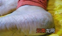 脚脱皮怎么办 一个偏方推荐