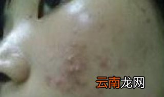 脸上老长痘痘怎么办 如何做才能快速有效地祛除脸上痘痘呢