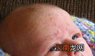 宝宝长湿疹怎么办 需要注意这几点