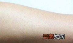 毛囊角质化怎么办 三个治疗方法推荐