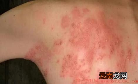 起泡疹高 疱疹刚开始症状图片