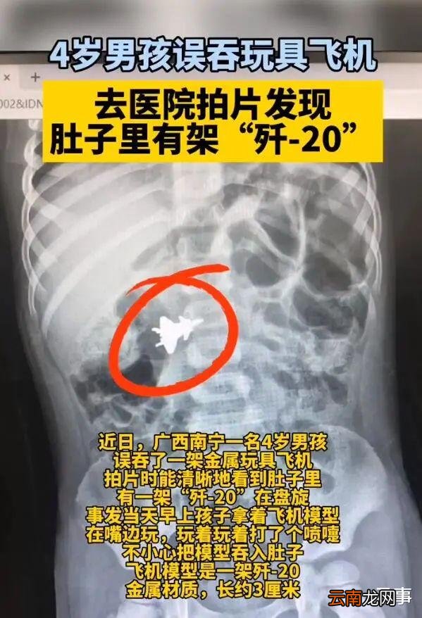 4岁男孩就诊发现肚子里有架歼20：不看好孩子，误食可以在瞬间发生